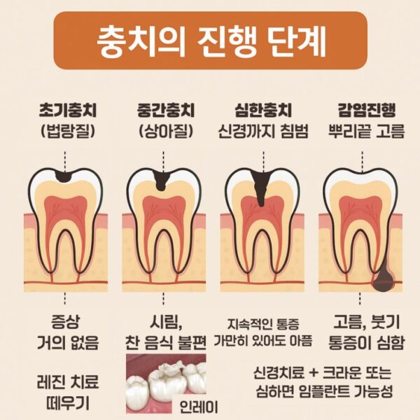 충치의 진행 단계와 치료 방법
