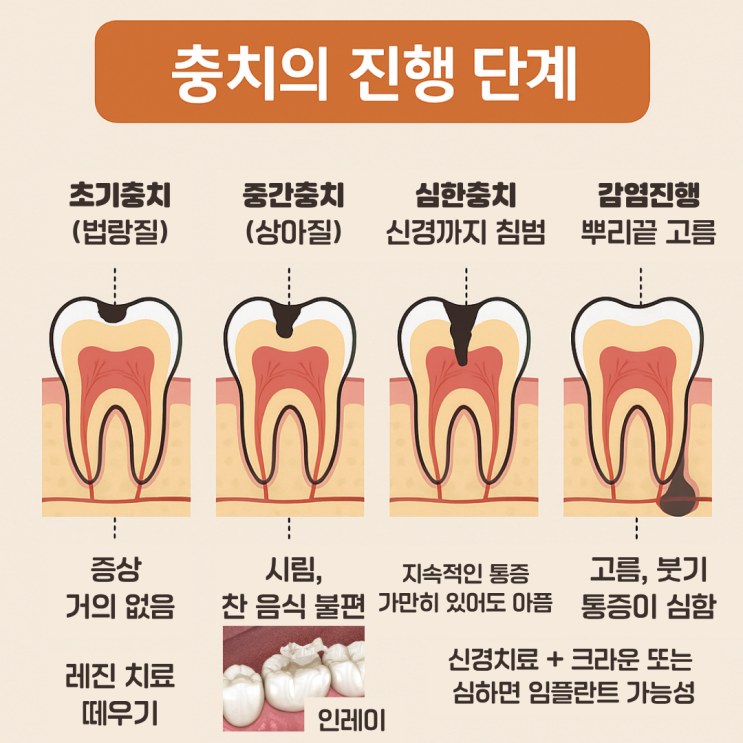 충치의 진행 단계와 치료 방법