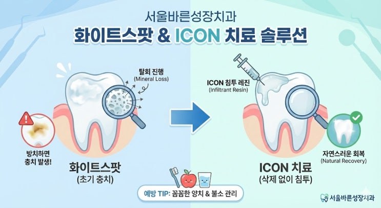 화이트스팟과 ICON 치료 원리