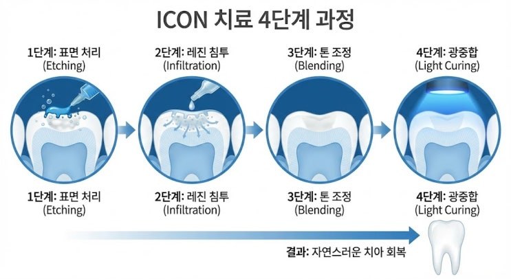ICON 치료 4단계 과정