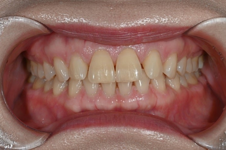 미세한 조정만 들어간 라미네이트 치아