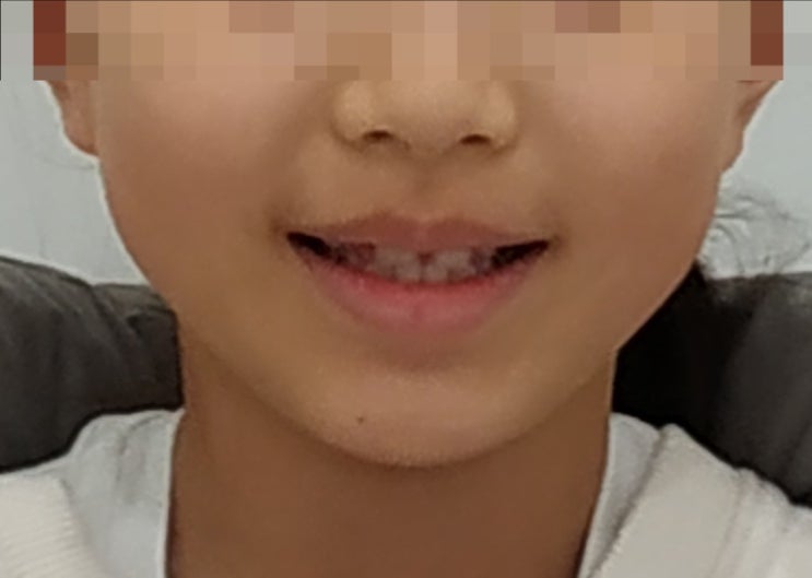 측절치 결손 교정 전 정면 미소