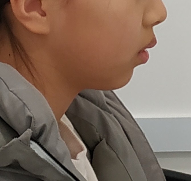 측절치 결손 교정 전 옆모습 - 입술 돌출