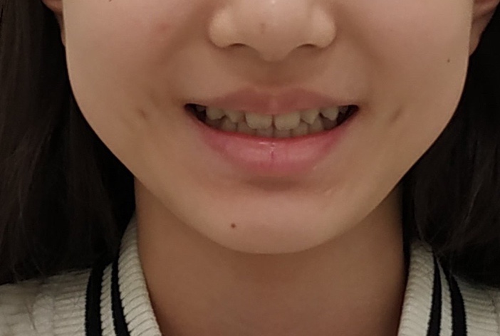 측절치 결손 교정 후 정면 미소