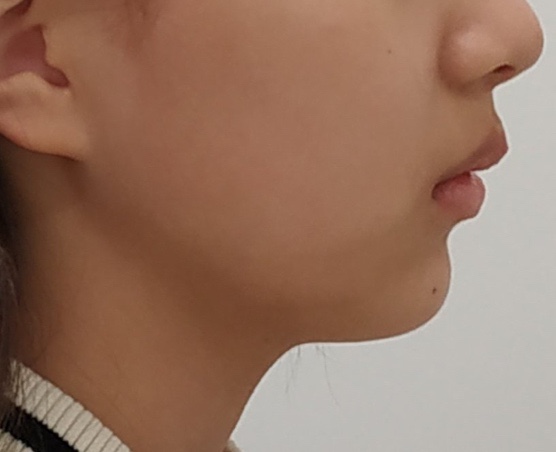 측절치 결손 교정 후 옆모습 - 입술 돌출과 턱선 개선