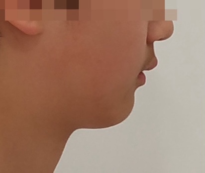 무턱교정 전 옆모습 - 2급 부정교합 아동