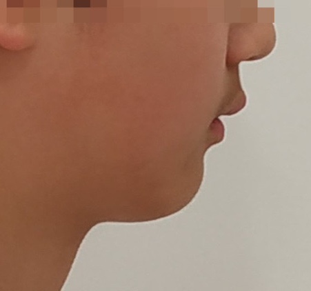 무턱교정 전 옆모습 비교