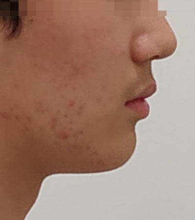 무턱교정 완료 후 옆모습