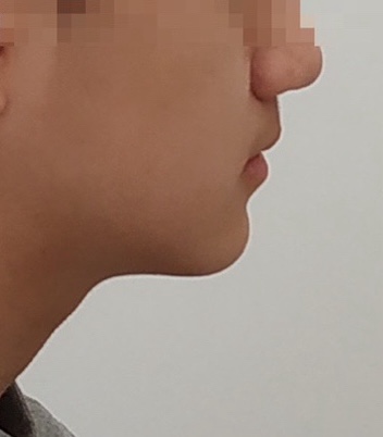 비발치 교정 전 옆모습
