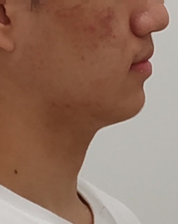 비발치 교정 후 옆모습