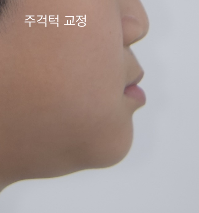 페이스마스크 주걱턱 교정 전 옆모습