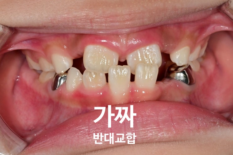 가짜 반대교합 어린이 구강 사진 - 아래 앞니가 위로 솟은 모습
