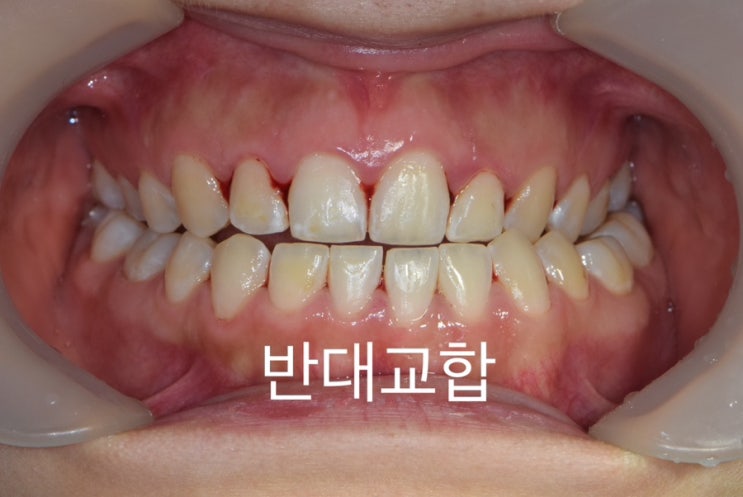 성인 주걱턱 반대교합 구강 정면