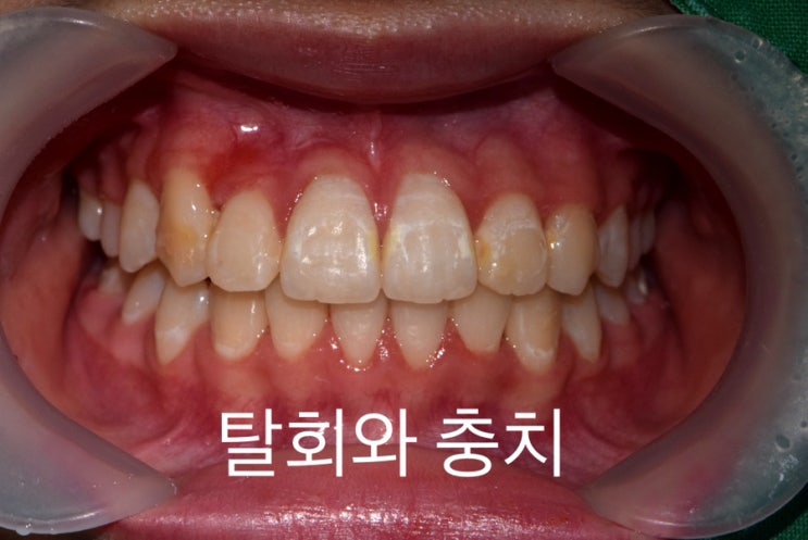 교정 장치 제거 후 브라켓 모양의 하얀 탈회와 충치