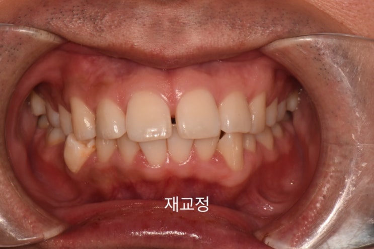 재교정 전 구강 정면 - 다시 벌어지고 뻗은 치아
