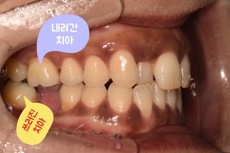 반대쪽 치아가 없어 아래로 내려온 치아와 쓰러진 치아