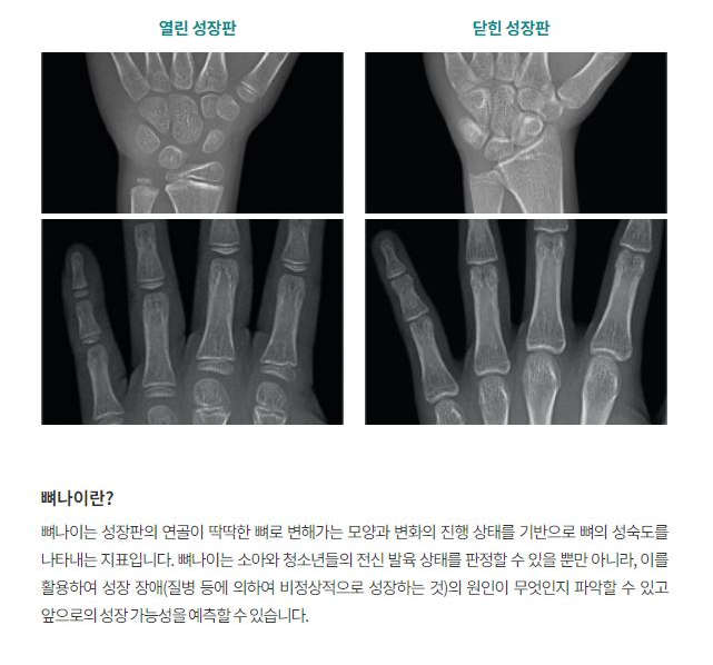 손 엑스레이로 보는 성장판 열림과 닫힘 비교