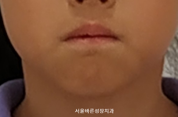 1차 교정 전 다문 입 모습