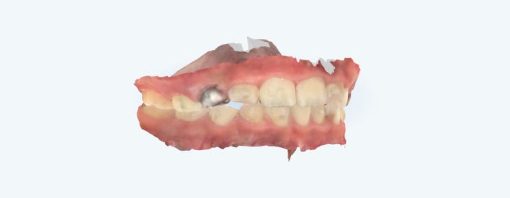 아이테로로 스캔한 구강 3D 이미지