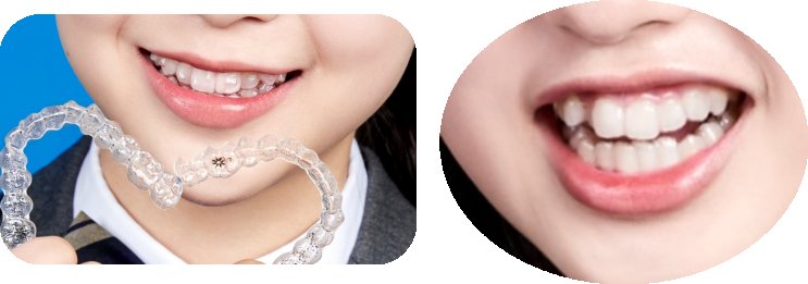 투명교정 장치를 든 아이와 브라켓 교정 중인 아이의 미소