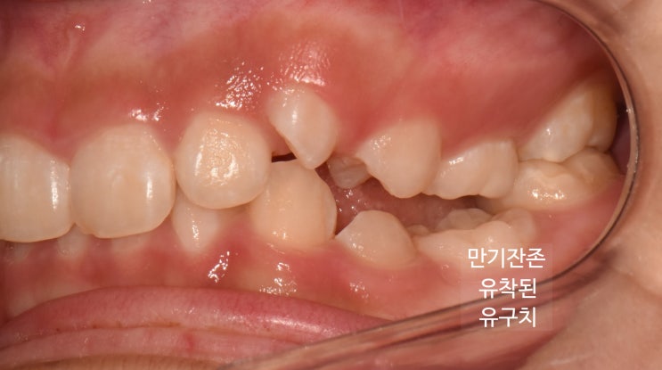 영구치 결손으로 남은 유치가 아래로 잠긴 침하치 구강 사진