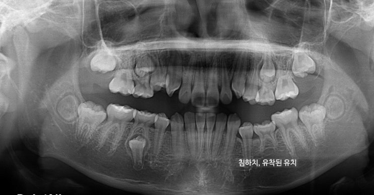 침하치와 영구치 결손 파노라마 엑스레이