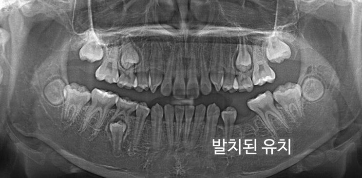침하된 유치 발치 후 파노라마