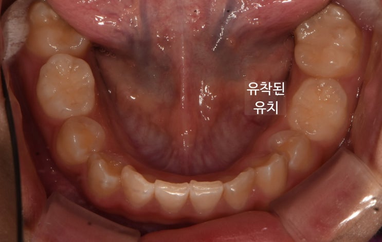 교정 전 아래턱 교합면 - 유착된 유치