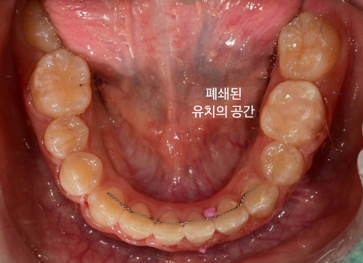 교정 후 아래턱 교합면 - 유치 공간이 닫힌 모습