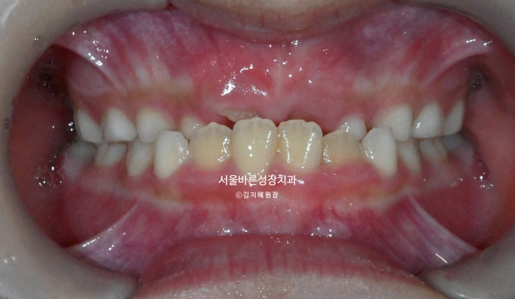 반대교합 개선 최적의 시기 구강 사진