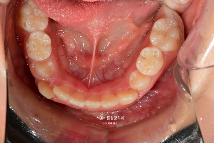 인비절라인 퍼스트 전 아래턱 - 덧니로 나온 송곳니