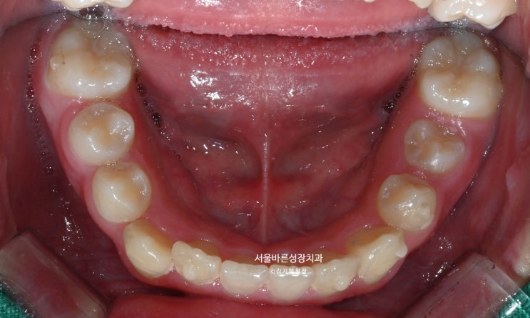 인비절라인 퍼스트 후 아래턱 - 제자리로 온 치아