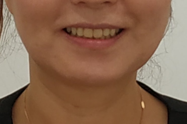 50대 벌어진 앞니 교정 후 미소 - 사례 1