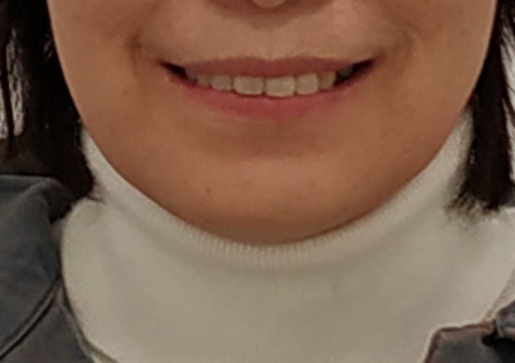 50대 벌어진 앞니 교정 후 미소 - 사례 2