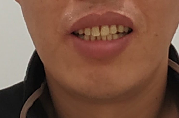 50대 벌어진 앞니 교정 후 미소 - 사례 3