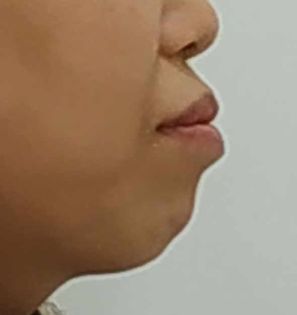 벌어진 앞니 교정 전 옆모습 - 입술 돌출
