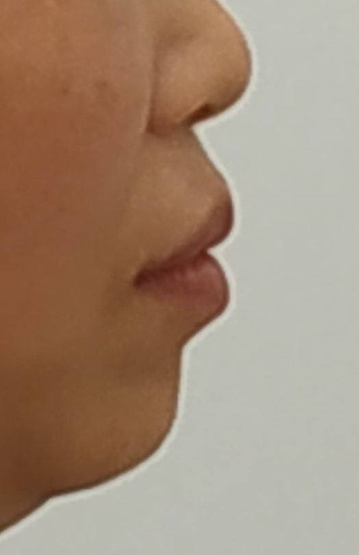 벌어진 앞니 교정 후 옆모습 - 입술이 들어간 모습