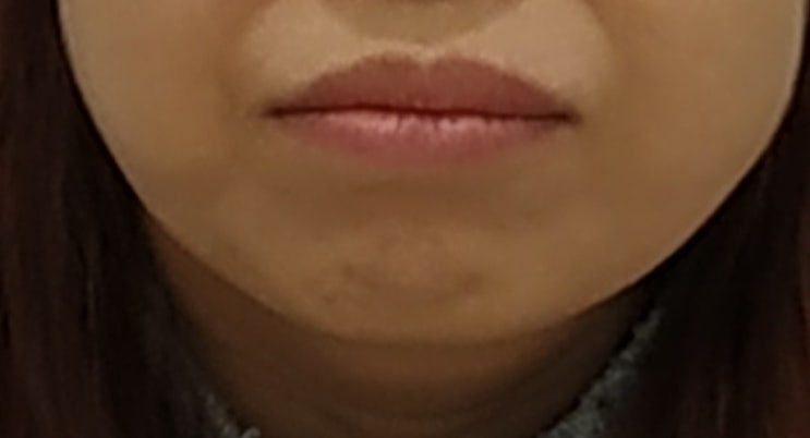 벌어진 앞니 교정 전 입매