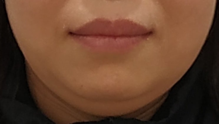 벌어진 앞니 교정 후 입매