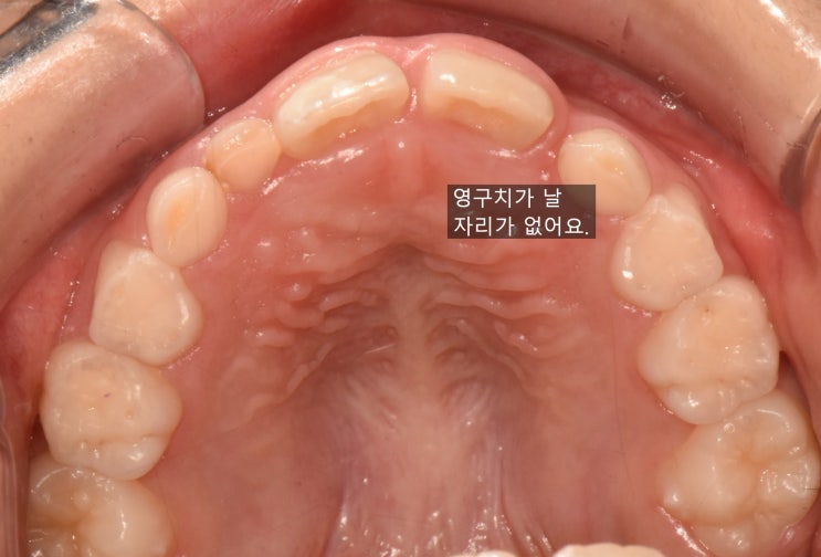 영구 앞니 2개만 나고 옆 영구치 자리가 없는 위턱