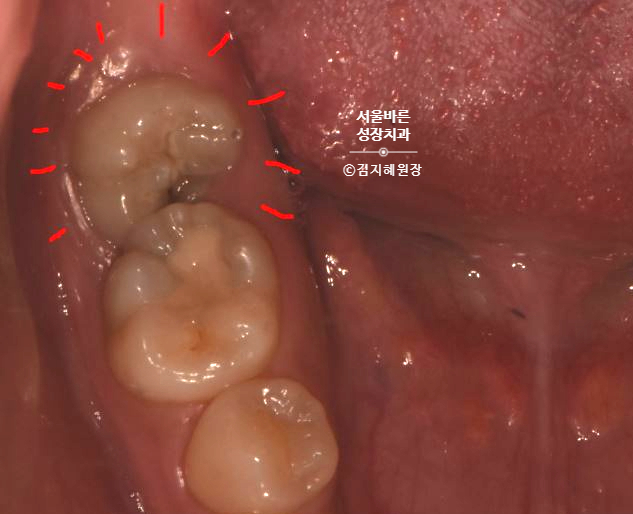 앞 어금니에 걸려 반쯤 나온 어금니가 썩은 구강 사진