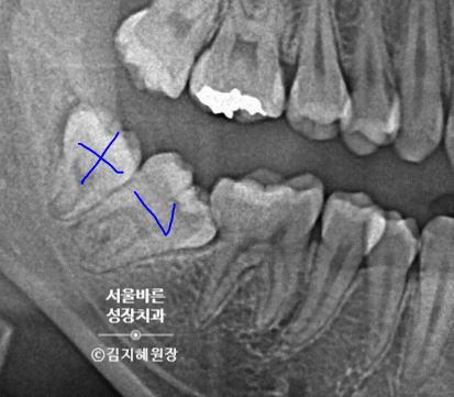 걸린 어금니와 사랑니 엑스레이