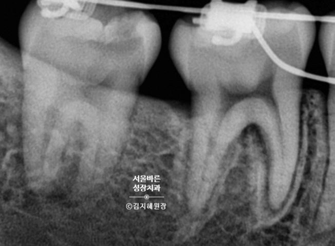 쓰러진 어금니를 세우는 교정 중 엑스레이