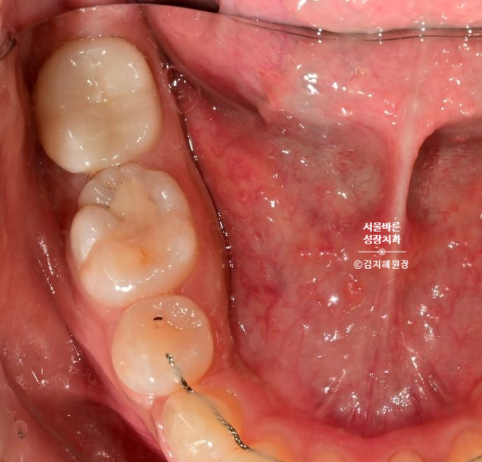 어금니를 세우고 지르코니아 크라운으로 마무리한 구강 사진