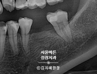 쓰러진 치아를 세워 임플란트 공간을 만든 엑스레이