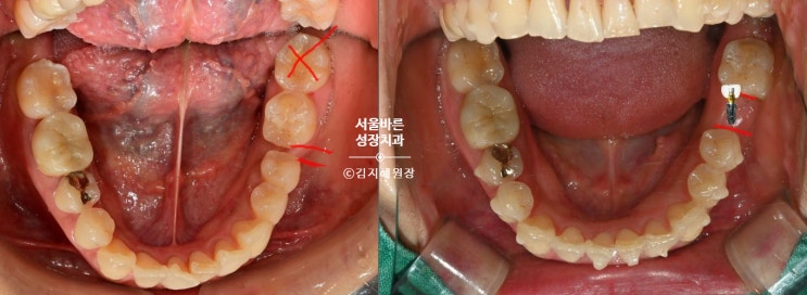 투명교정으로 어금니를 세우기 전후 구강 비교