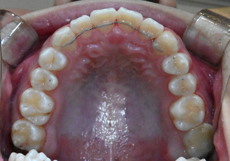 가위교합 교정 후 위턱 교합면