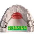 유치를 일찍 뺀 자리에 넣는 공간유지장치