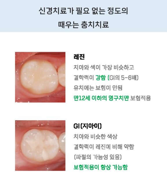 레진과 GI 재료 비교