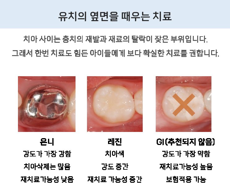 유치 옆면 충치를 떼우는 재료 비교